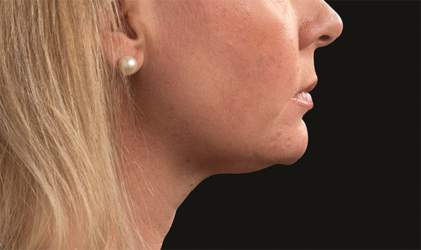 double chin under chin treatment coolsculpting nyc manhattan